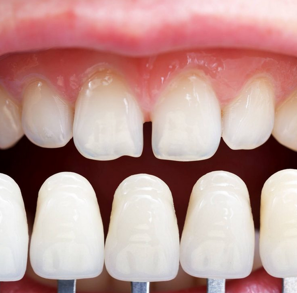 Dental Porcelain Crown