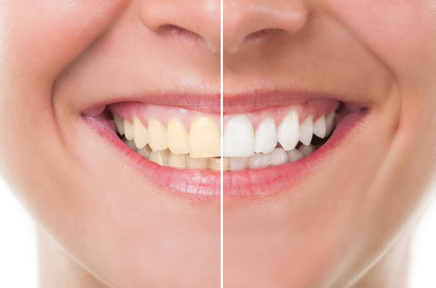Average Price for Dental Deep Cleaning
